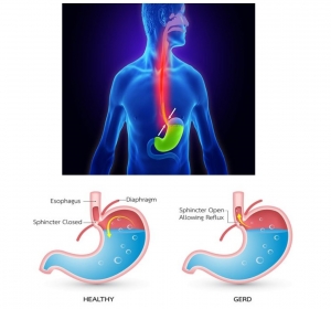 BAHAYA "GERD" (ANGIN TADUDU) BISA MENYEBABKAN KEMATIAN
